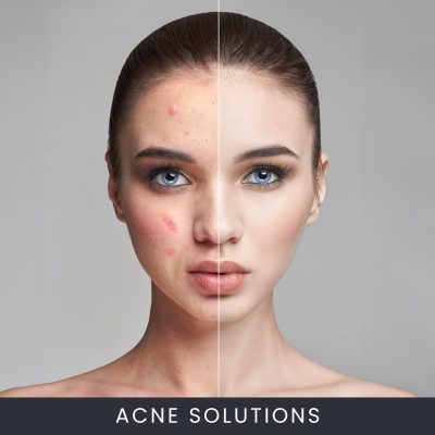 Acne Solutions Facial Course