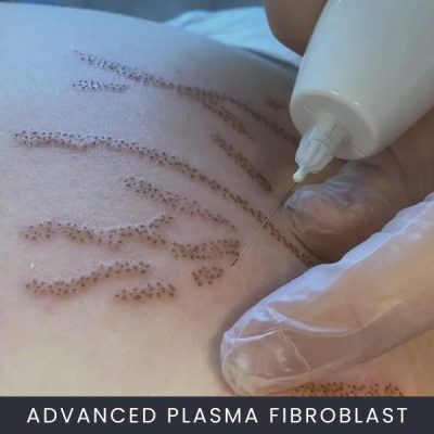 Advanced Plasma Fibroblast Online Course