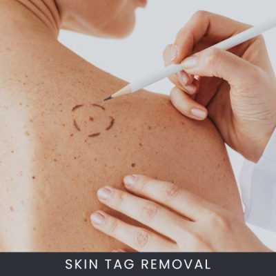 Skin Tag Removal Course