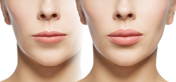 Online Carbon Laser Lip Plumping Course